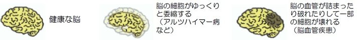 認知症①(健康な脳)